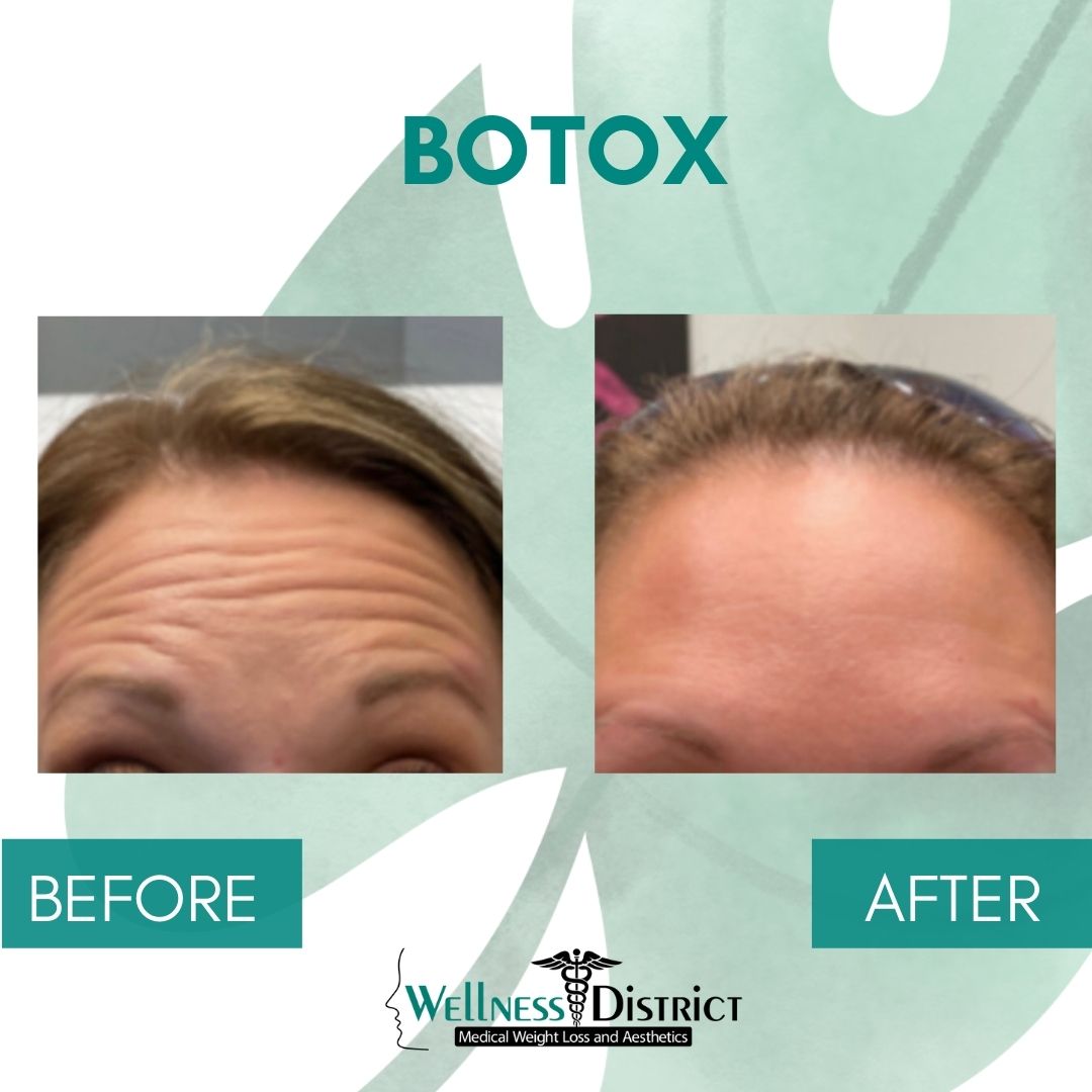 Botox Fargo ND Before And After Photo
