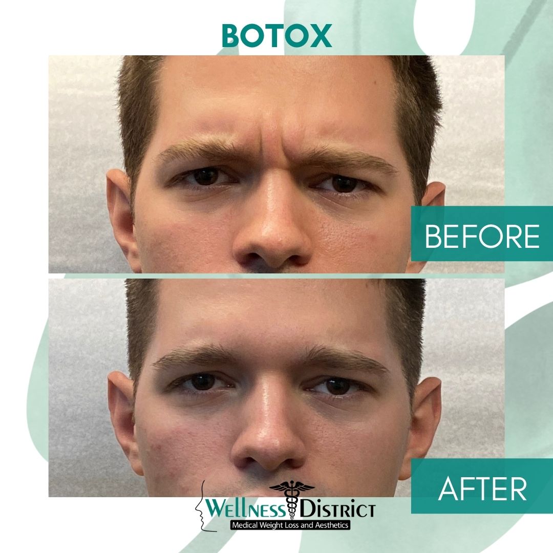 Botox Picture Before And After Photo