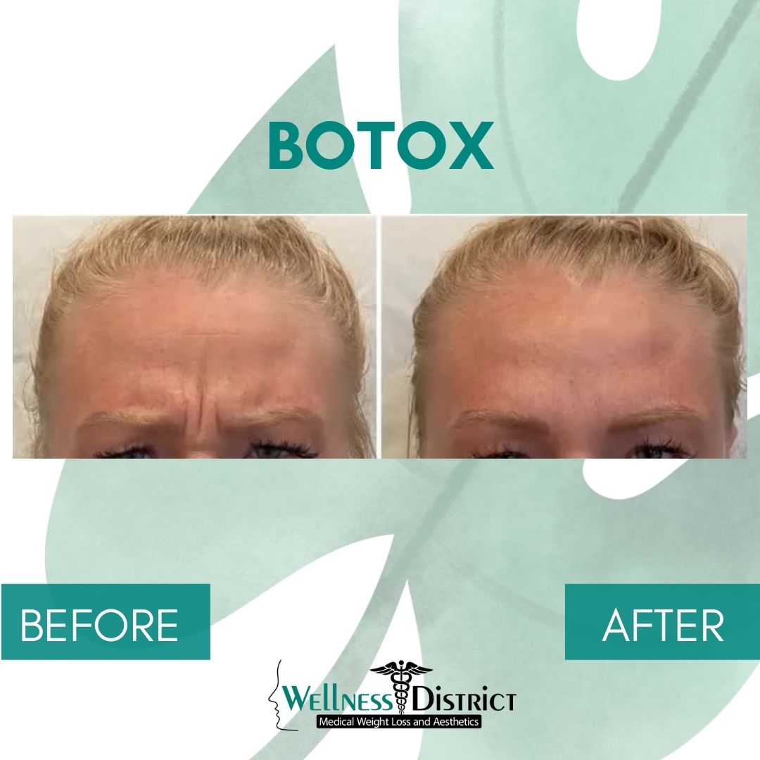 Botox In Fargo Before And After Photo