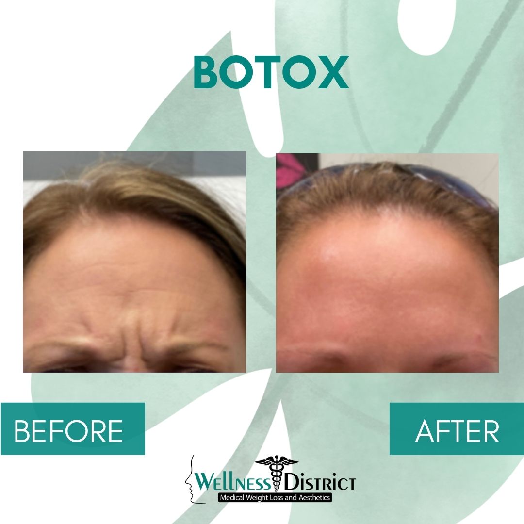 Before And After Botox Fargo ND