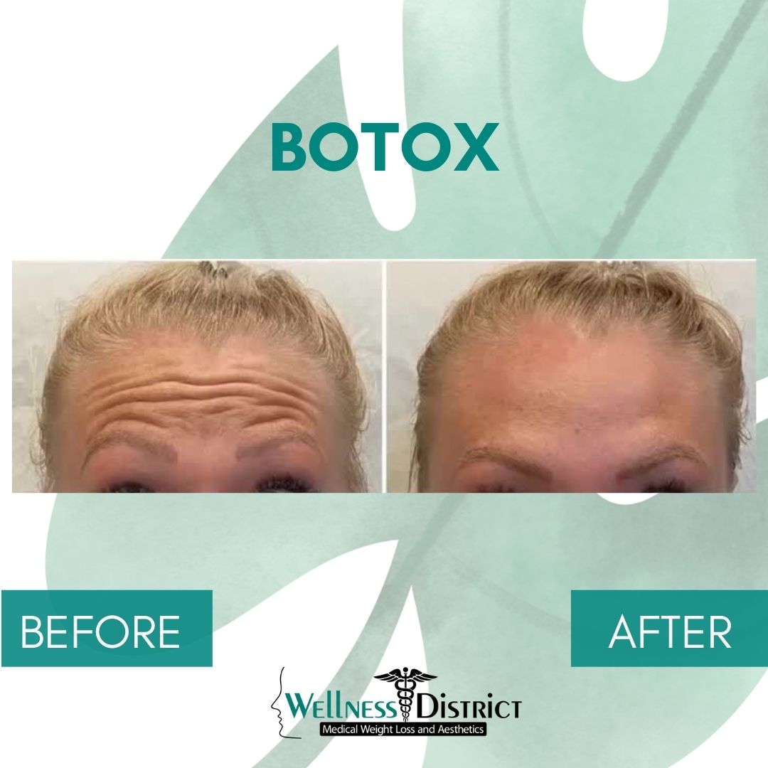 Before And After Botox In Fargo