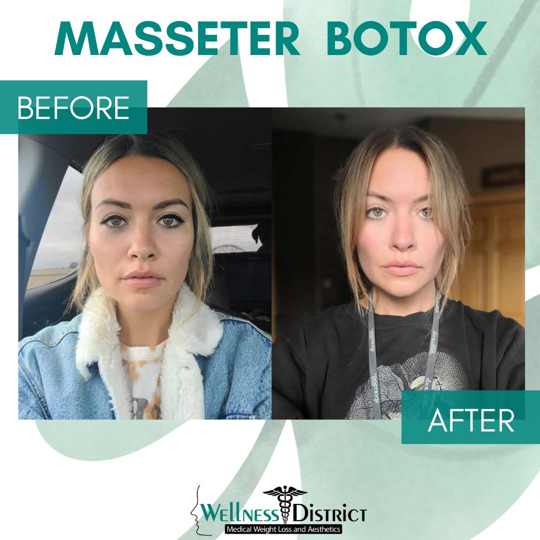 Before And After Botox Picture