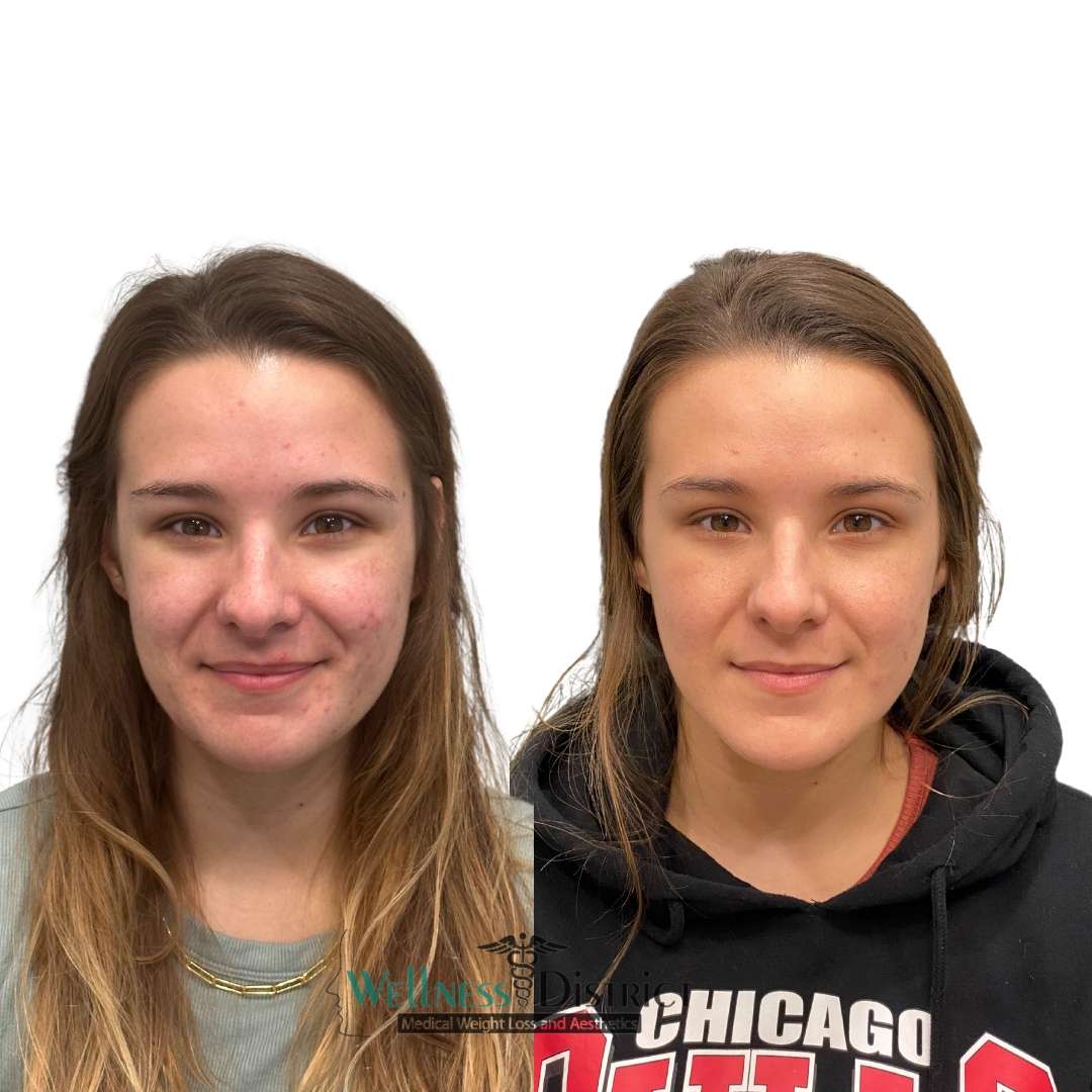 Botox Fargo ND Female patient before and after photo