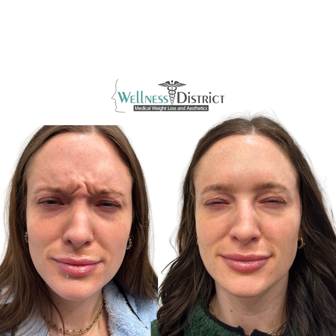 Botox Fargo ND Female patient before and after photo