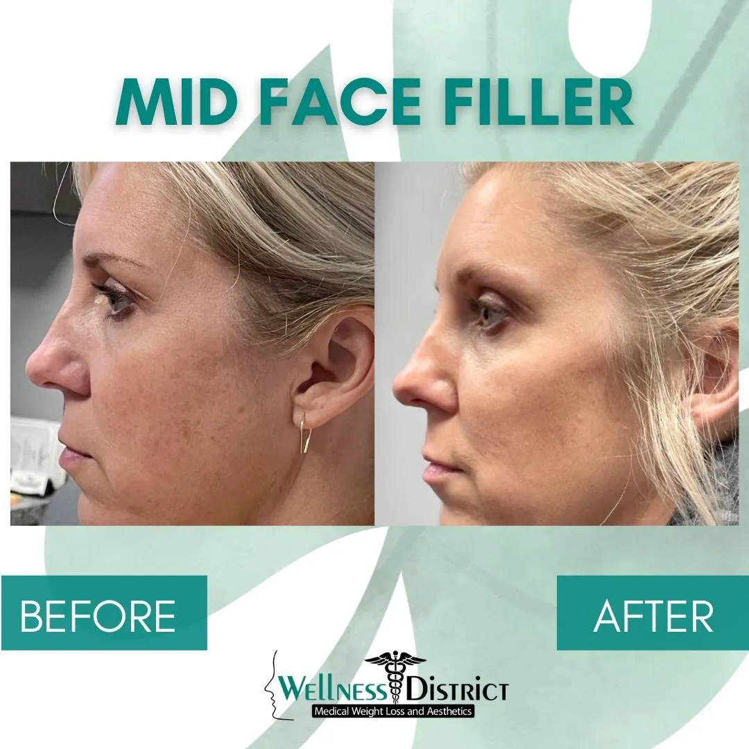 Lip Filler Patient Before & After