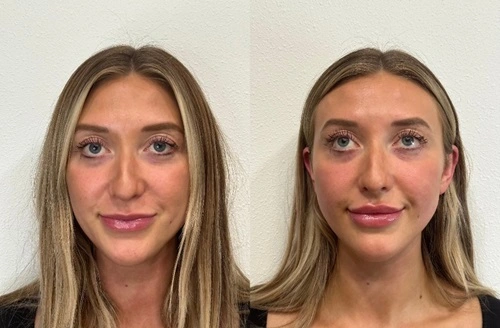 Lip Filler Patient Before & After