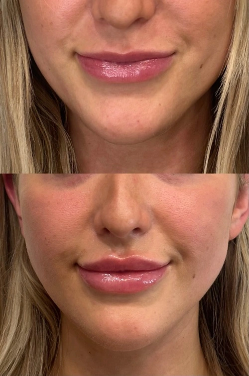 Before And After Lip Filler Fargo ND