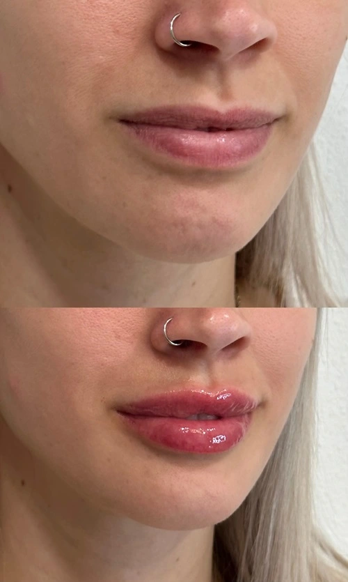 Lip Filler Fargo ND Female patient before and after photo