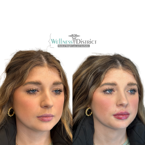 Lip Filler Picture Before And After Photo