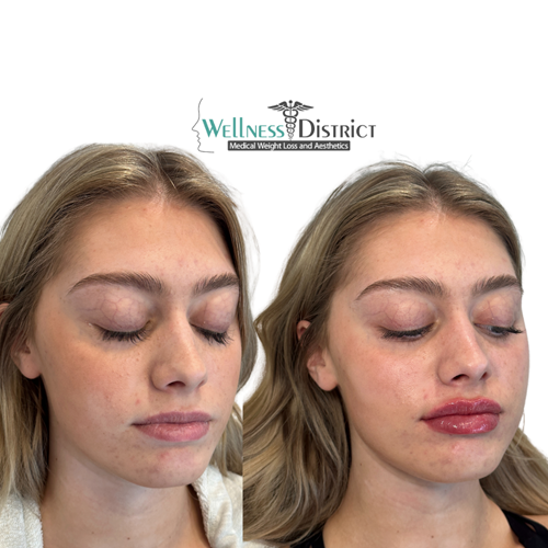 Before And After Lip Filler Picture