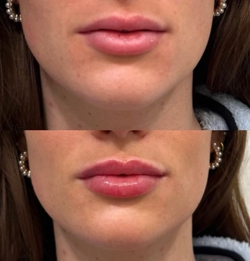 Lip Filler Fargo ND Female patient before and after photo