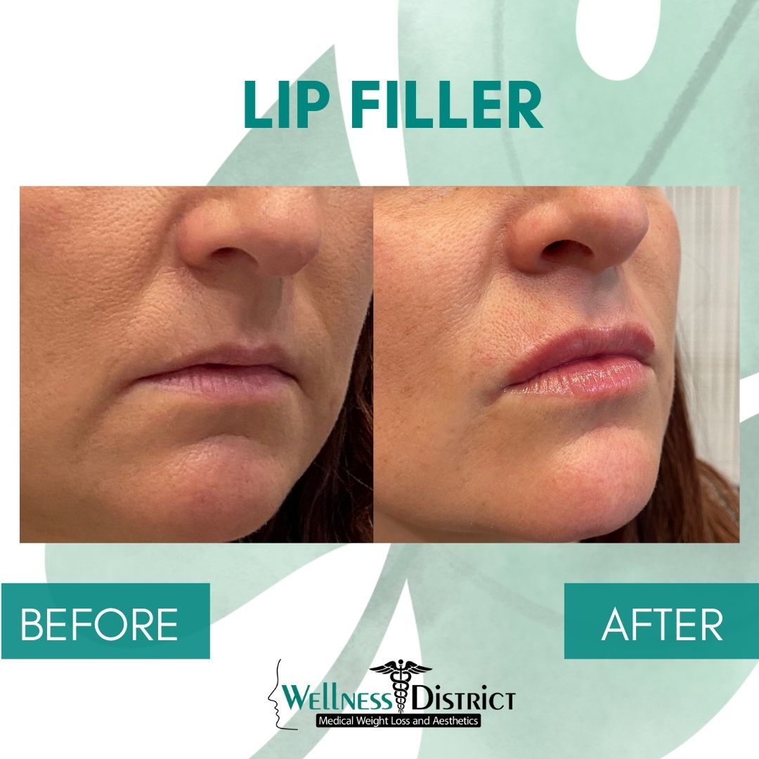 Maximizing Your Lip Filler Results: Essential Pre-and Post-Treatment  Instructions for Patients in Fargo, ND