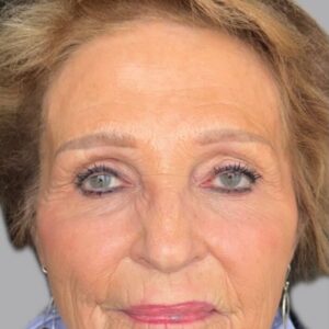 bbl + moxi treatment before and after