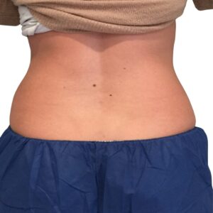 3 coolsculpting after