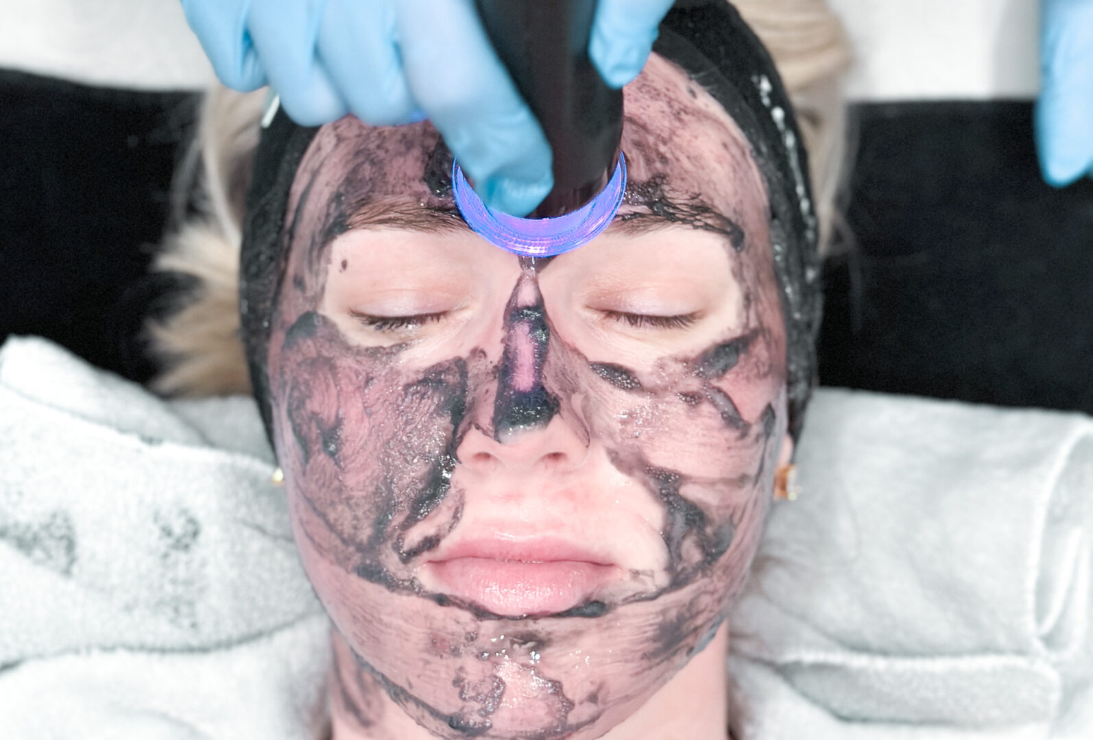 Aesthetic Patient Receiving A Medspa Glo2Facial at Wellness District Fargo