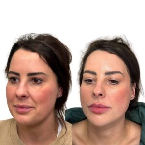 FULL FACE FILLER 2