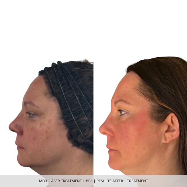 Moxi Laser Before and After in Fargo