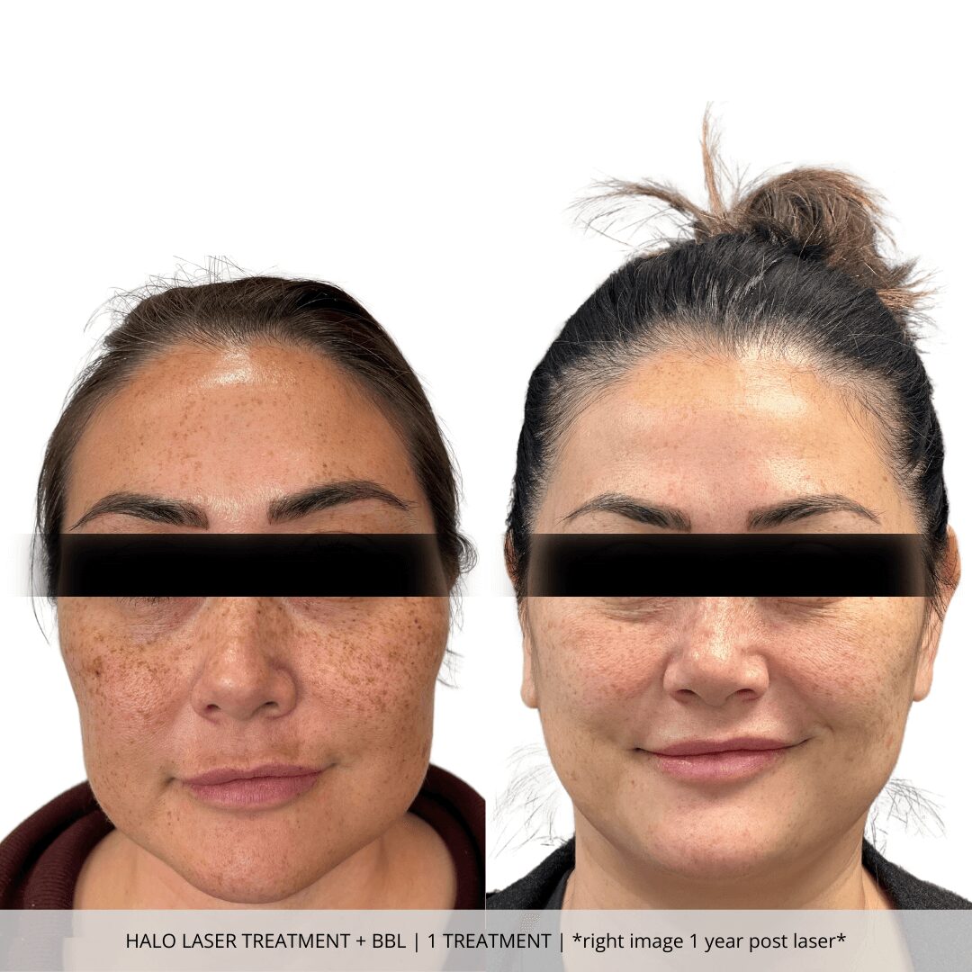 Halo Laser Treatment + BBL | 1 Treatment