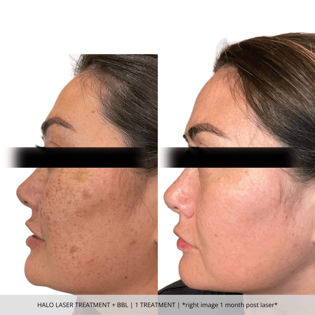 Halo Laser Treatment + BBL | 1 Treament