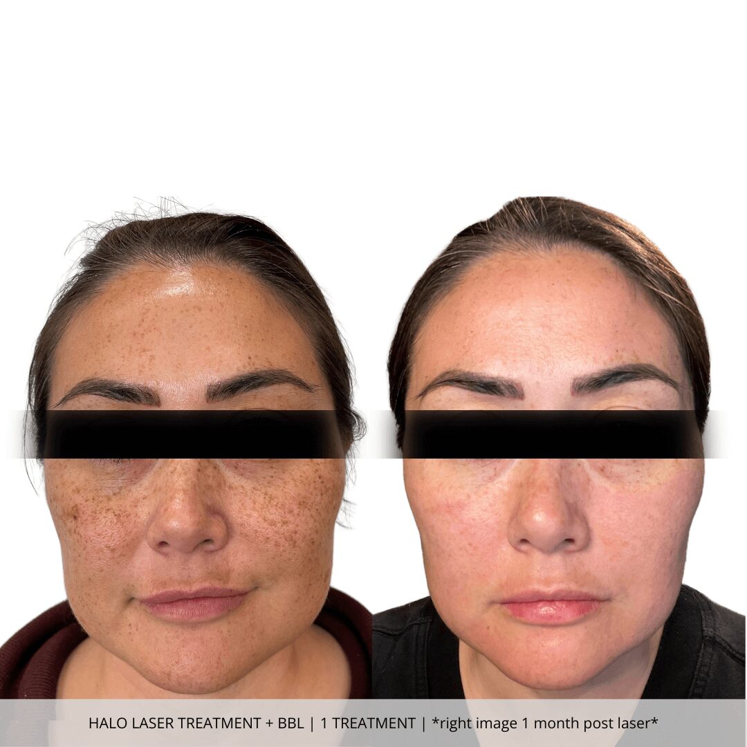 Halo Laser Treatment + BBL