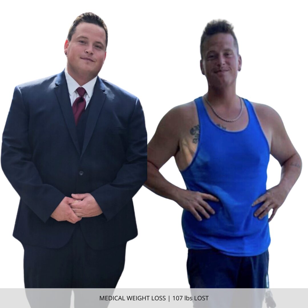 Medical Weight Loss | 107 lbs Lost