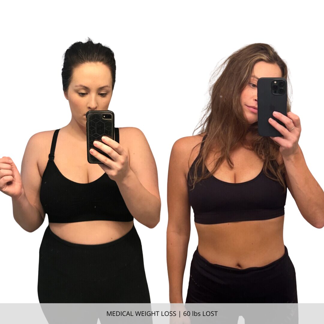 Medical Weight Loss | 60 lbs Lost