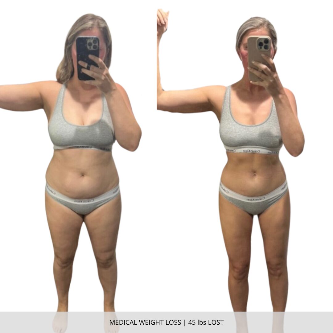 Medical Weight Loss | 45 lbs Lost