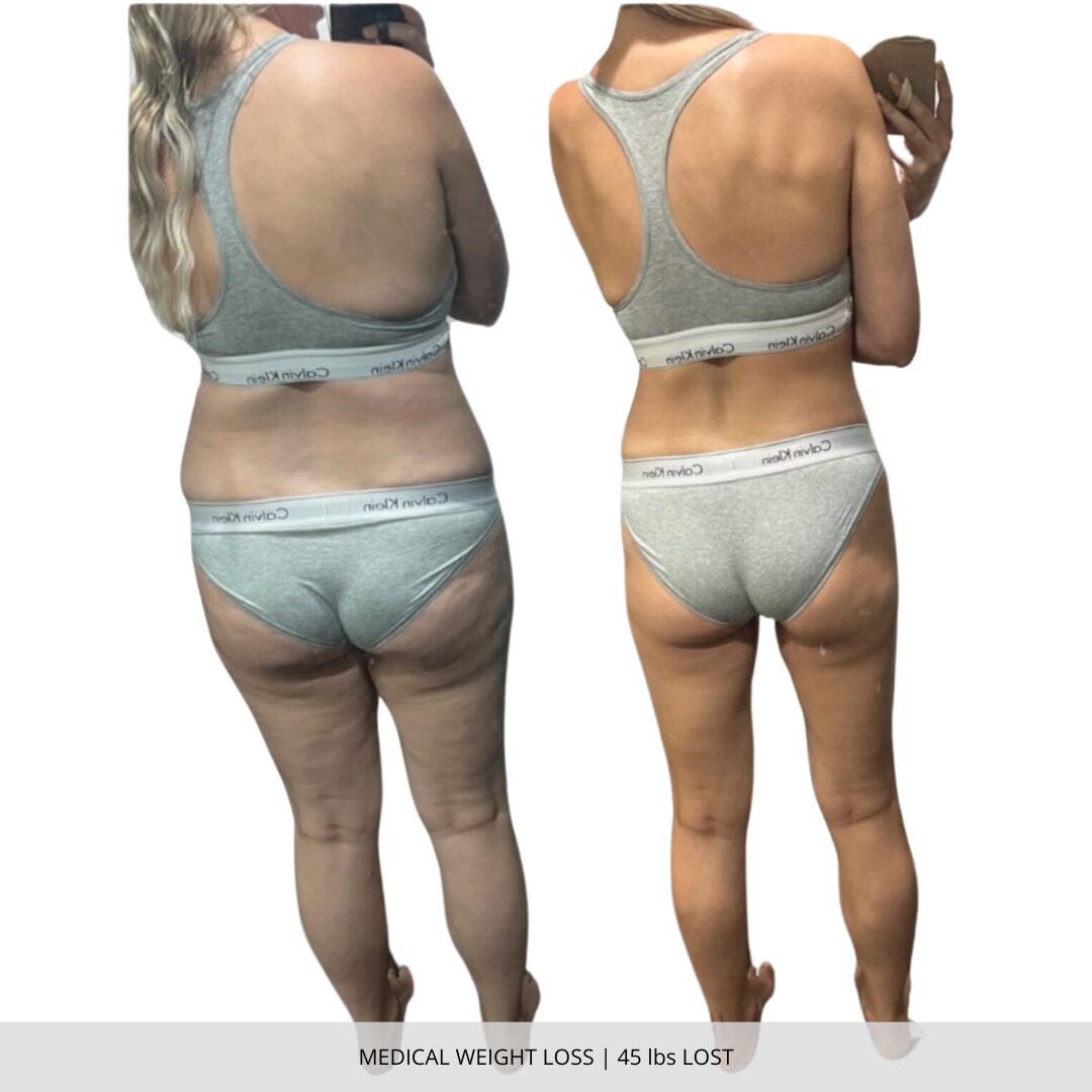 Medical Weight Loss | 45 lbs Lost