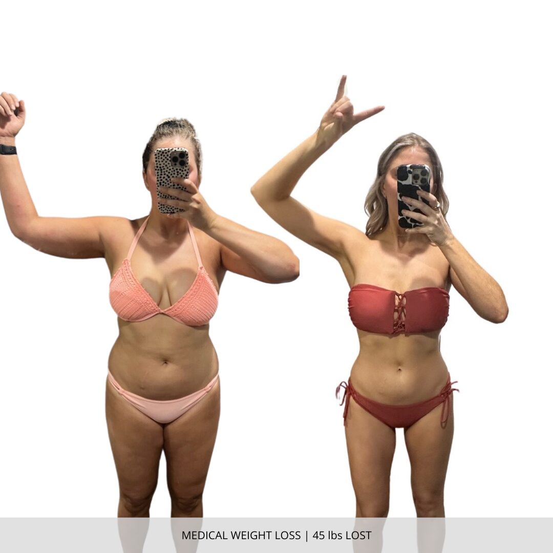 Medical Weight Loss | 45 lbs Lost