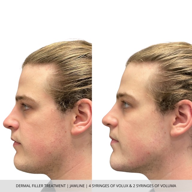 Dermal Filler Before and After for Jawline using Volux and Voluma in Fargo