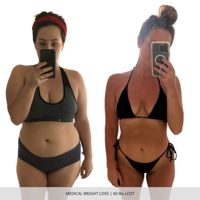 Fargo Medical Weight Loss Before and After