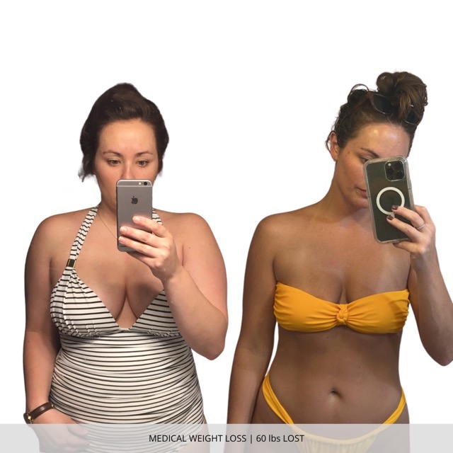 Fargo Medical Weight Loss Before and After
