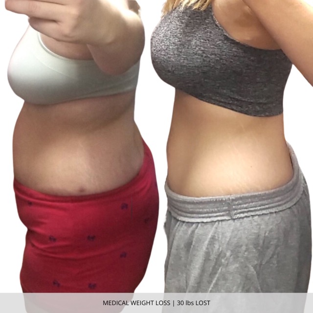 Fargo Medical Weight Loss Before and After